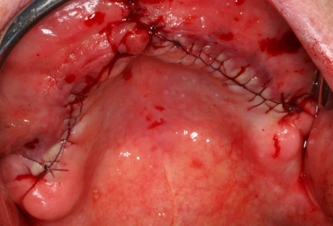 06/10 botiss maxresorb® and collprotect® membrane for bone splitting - case by Dr J Neugebauer