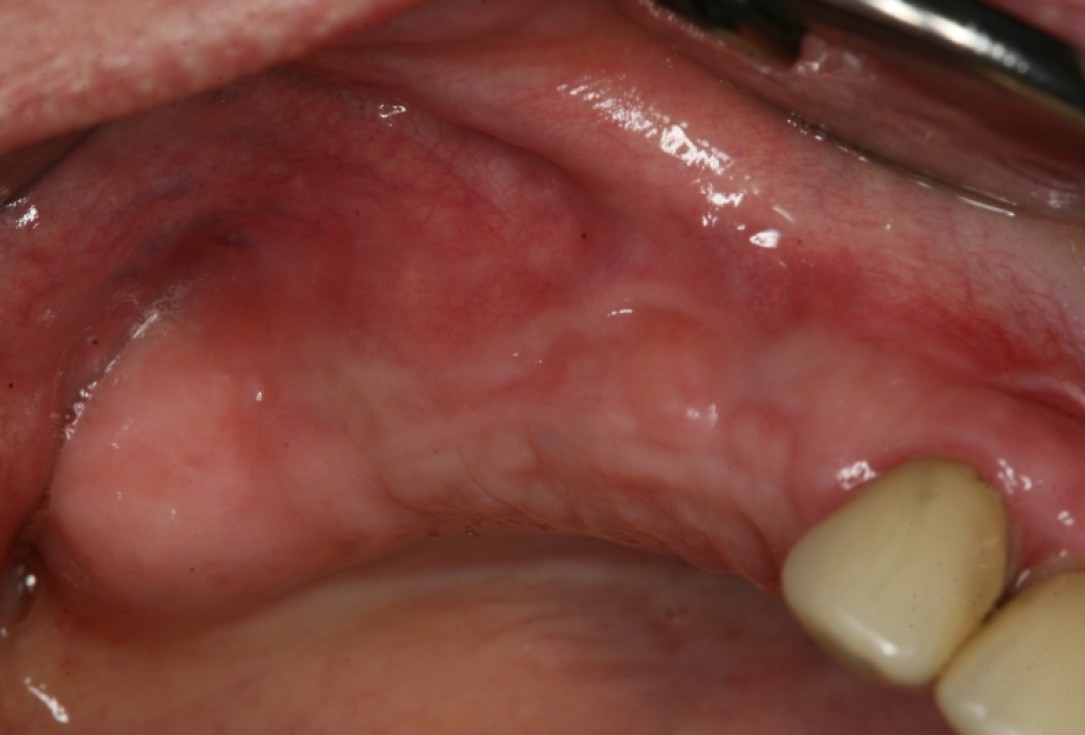 botiss maxresorb®, Jason fleece® and collprotect® membrane for sinus lift and simultaneous implantation - case by Dr. F. Kistler