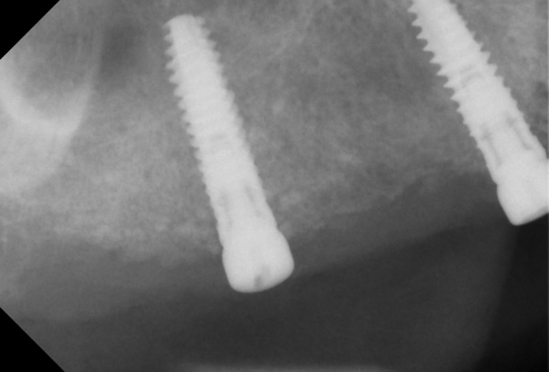 botiss maxresorb®, Jason fleece® and collprotect® membrane for sinus lift and simultaneous implantation - case by Dr. F. Kistler