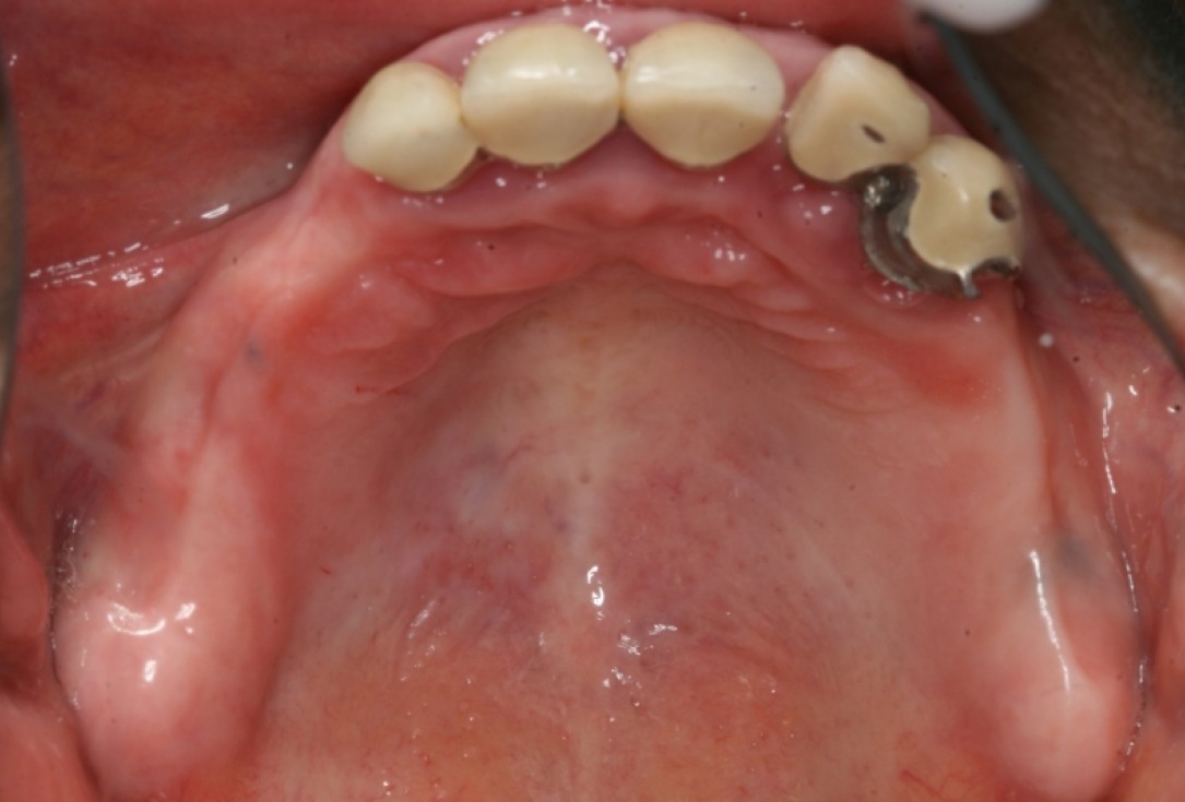 botiss maxresorb®, Jason fleece® and collprotect® membrane for sinus lift and simultaneous implantation - case by Dr. F. Kistler