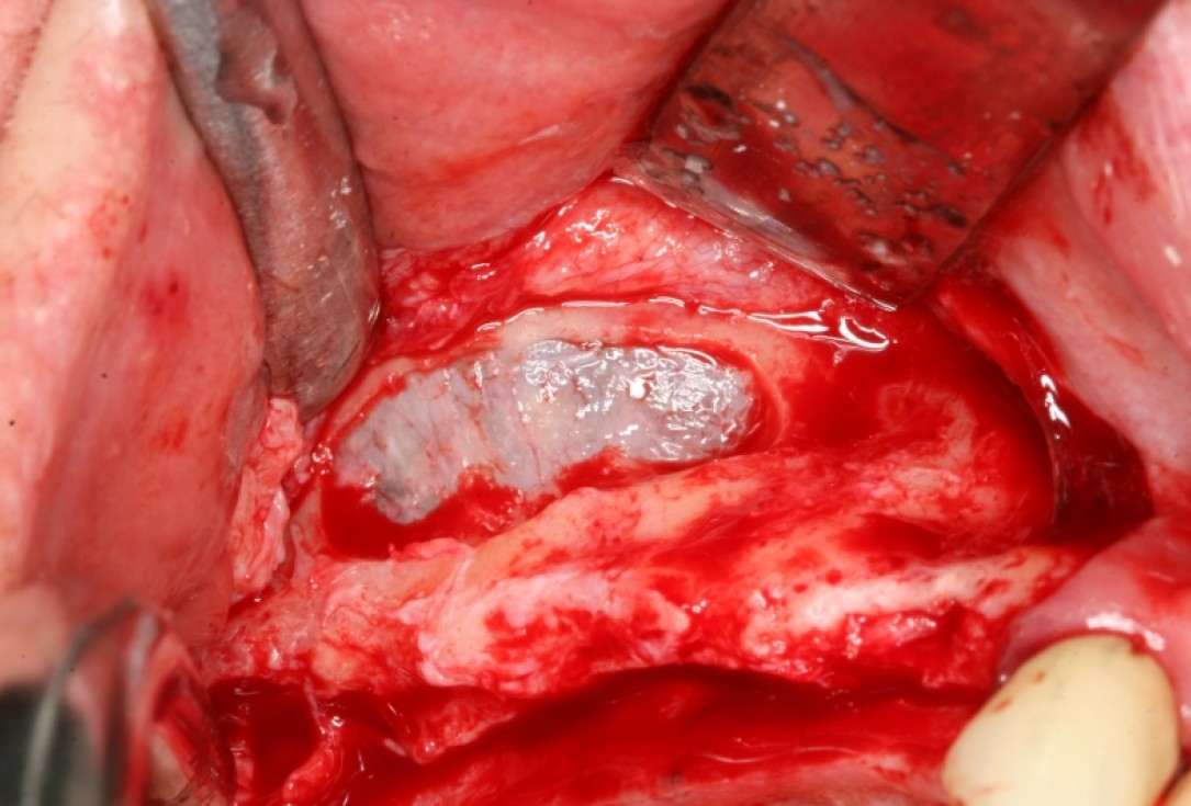 botiss maxresorb®, Jason fleece® and collprotect® membrane for sinus lift and simultaneous implantation - case by Dr. F. Kistler