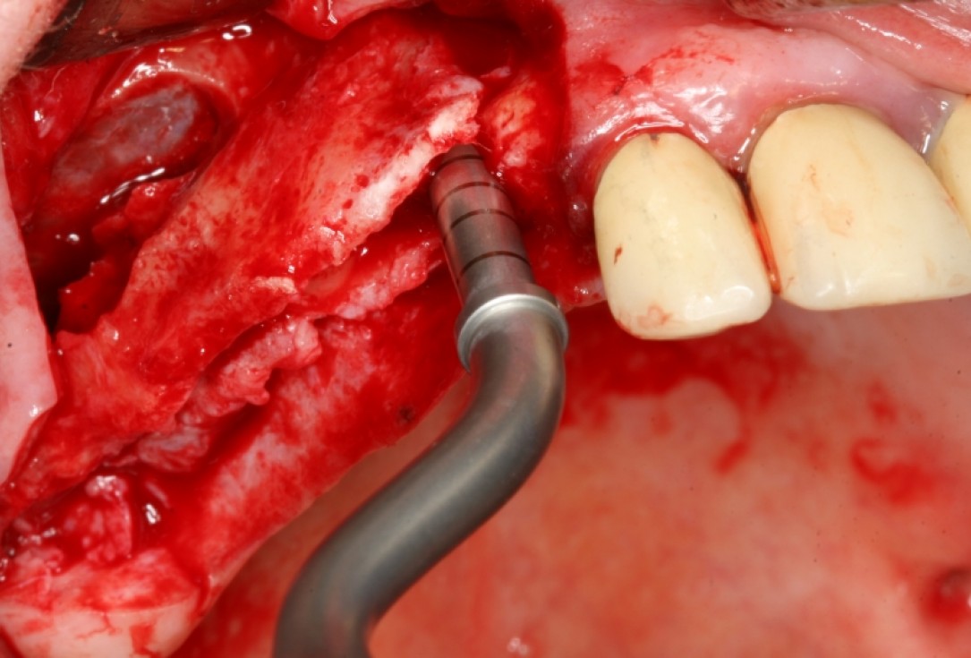 botiss maxresorb®, Jason fleece® and collprotect® membrane for sinus lift and simultaneous implantation - case by Dr. F. Kistler