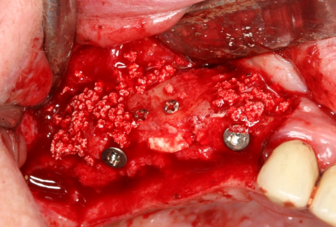botiss maxresorb®, Jason fleece® and collprotect® membrane for sinus lift and simultaneous implantation - case by Dr. F. Kistler