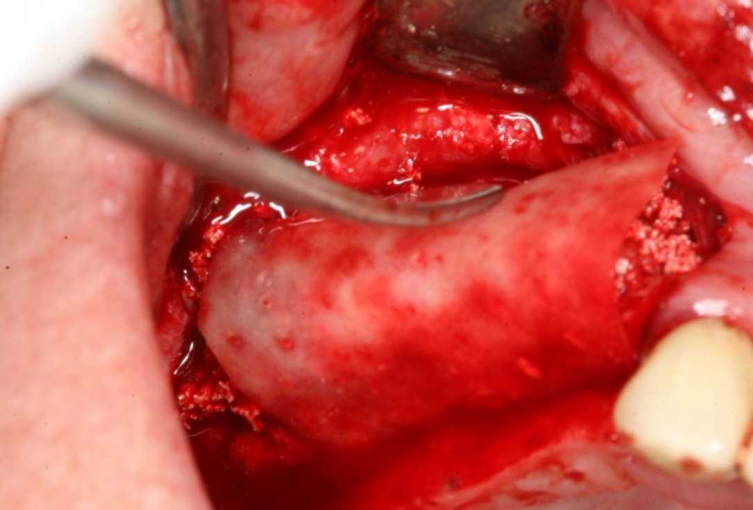 botiss maxresorb®, Jason fleece® and collprotect® membrane for sinus lift and simultaneous implantation - case by Dr. F. Kistler