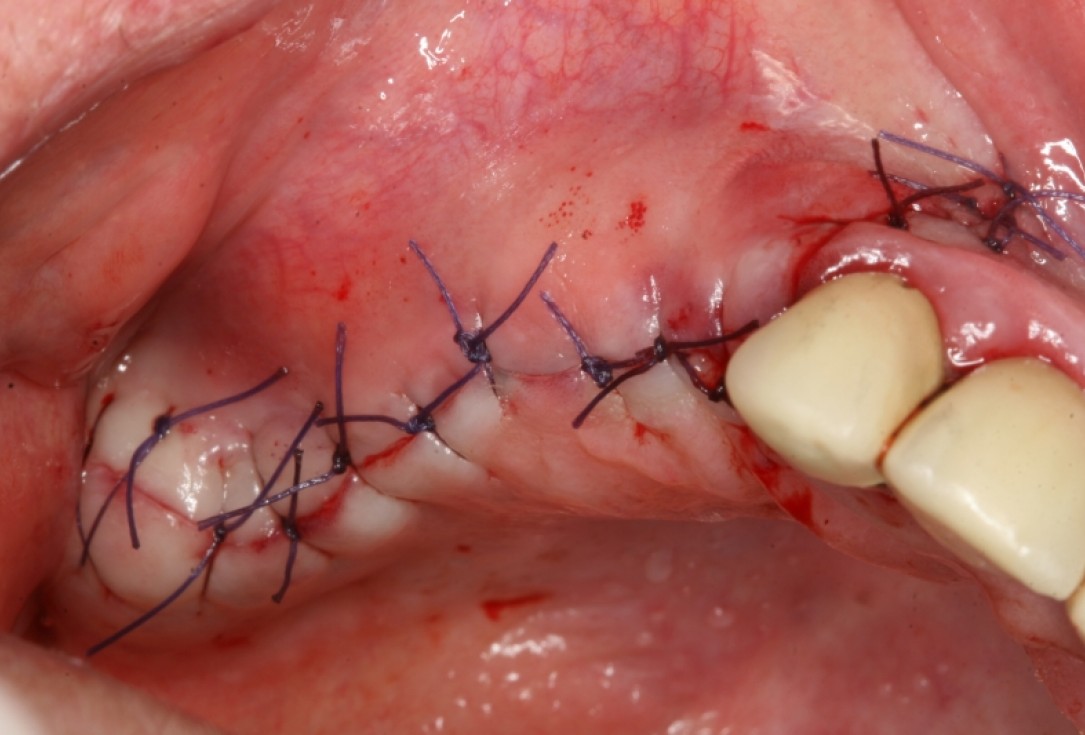 botiss maxresorb®, Jason fleece® and collprotect® membrane for sinus lift and simultaneous implantation - case by Dr. F. Kistler