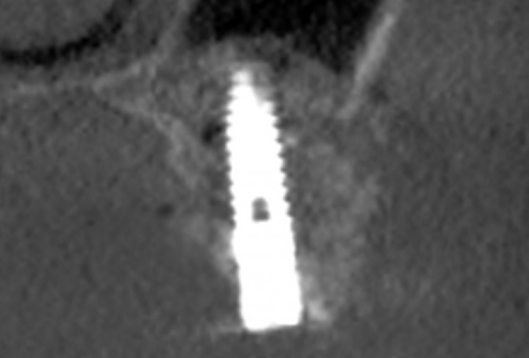 botiss maxresorb®, Jason fleece® and collprotect® membrane for sinus lift and simultaneous implantation - case by Dr. F. Kistler