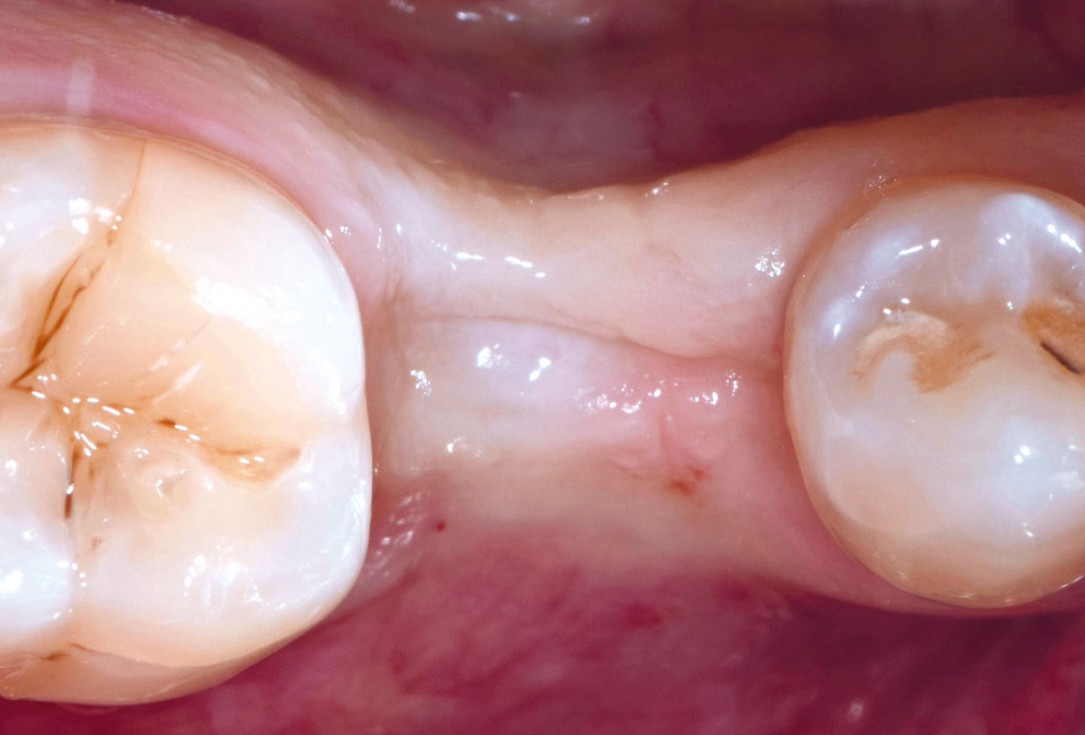 10/17 mucoderm® around single implant at second stage surgery