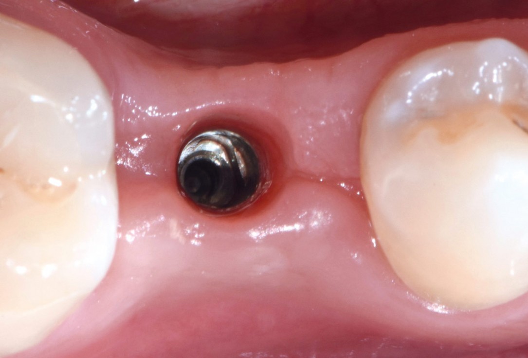 14/17 mucoderm® around single implant at second stage surgery