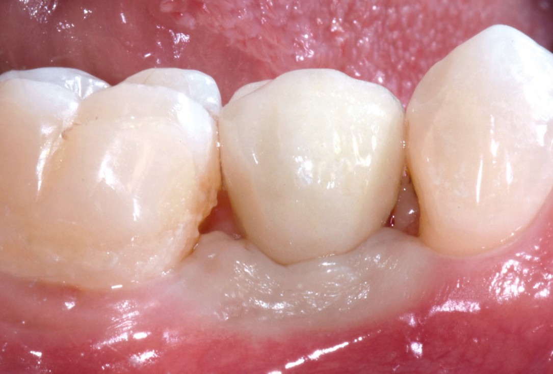 15/17 mucoderm® around single implant at second stage surgery