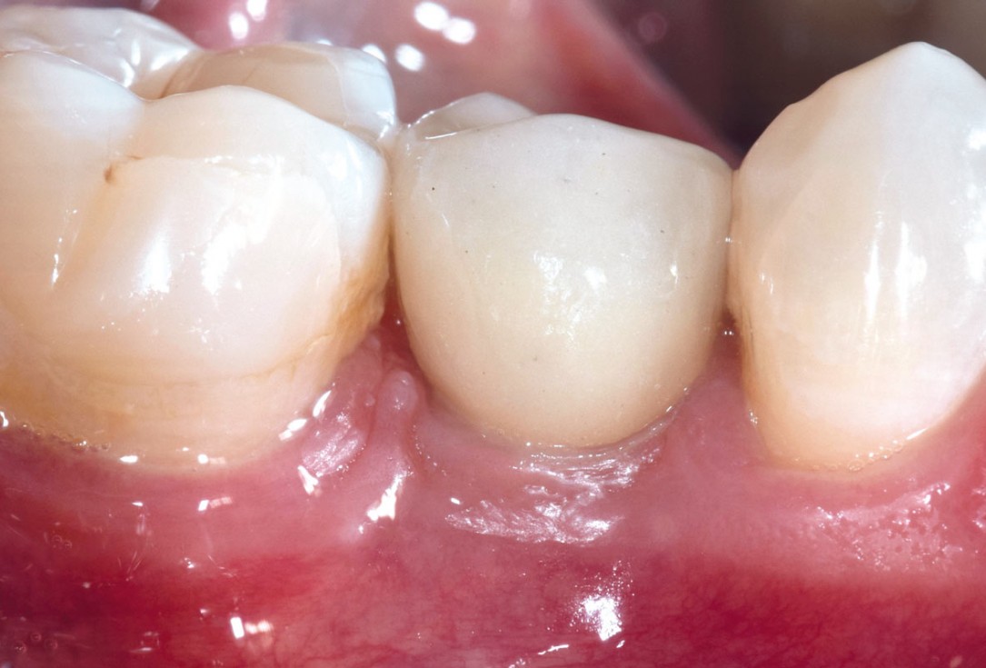 16/17 mucoderm® around single implant at second stage surgery