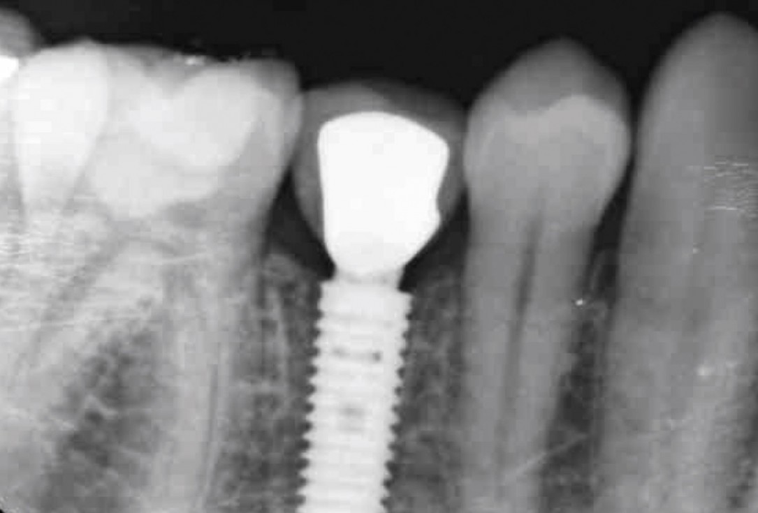 17/17 mucoderm® around single implant at second stage surgery