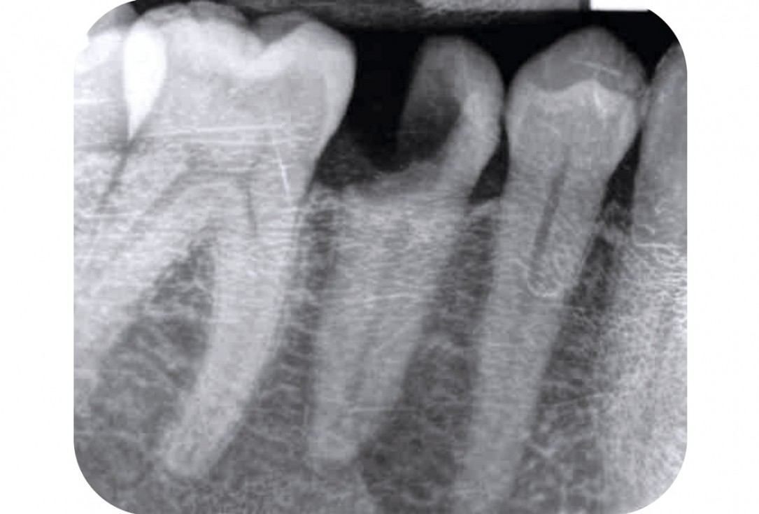 3/17 mucoderm® around single implant at second stage surgery