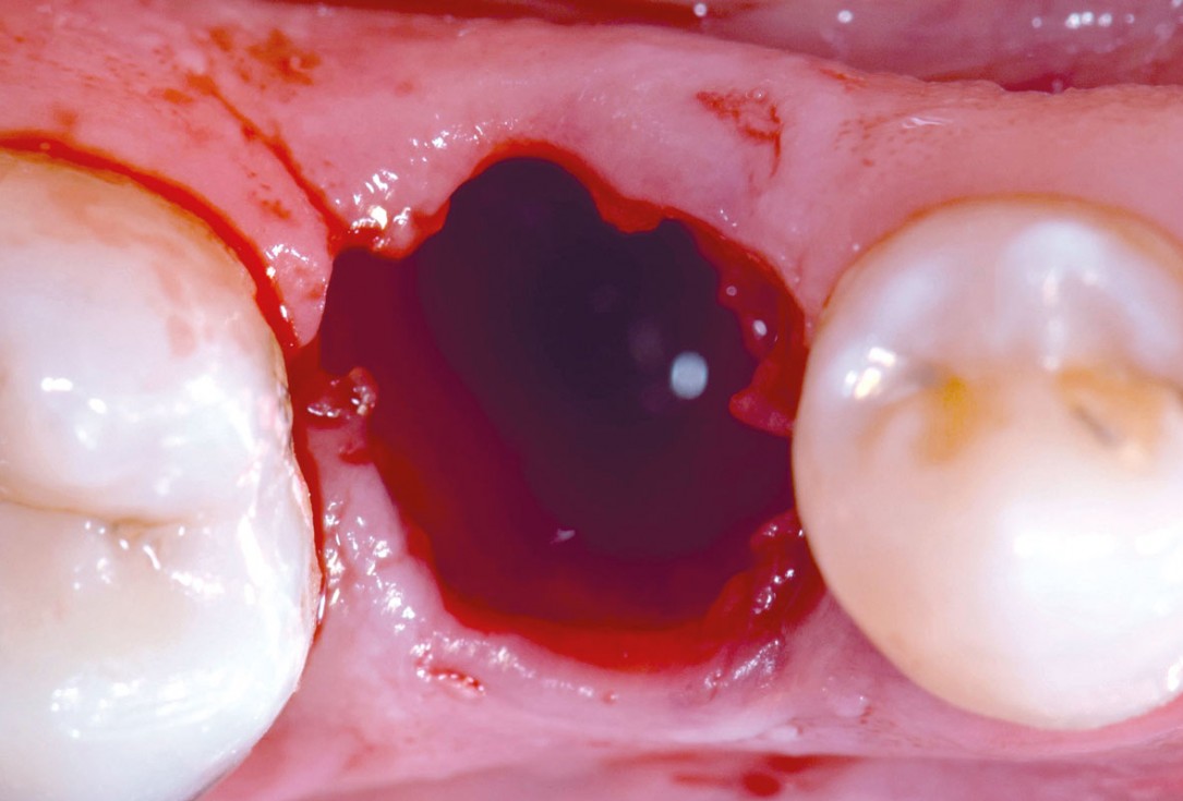 4/17 mucoderm® around single implant at second stage surgery