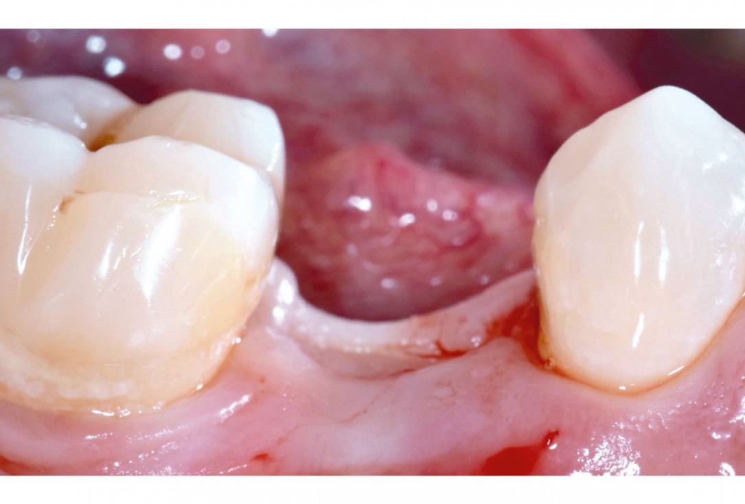 7/17 mucoderm® around single implant at second stage surgery