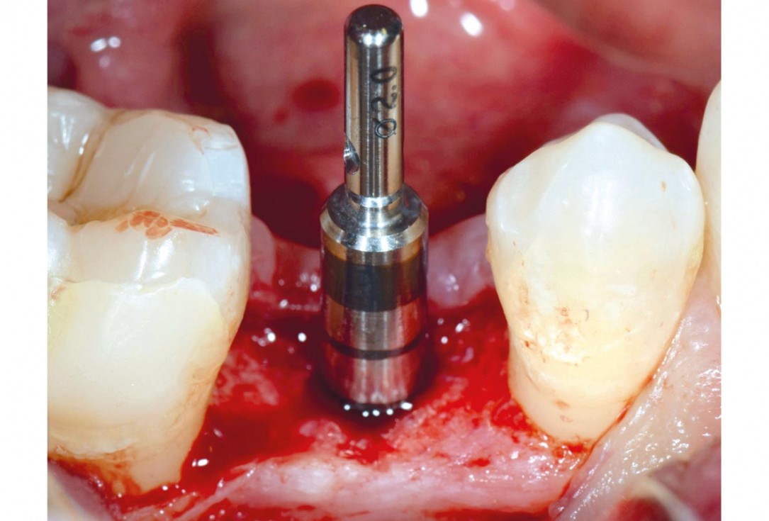 9/17 mucoderm® around single implant at second stage surgery