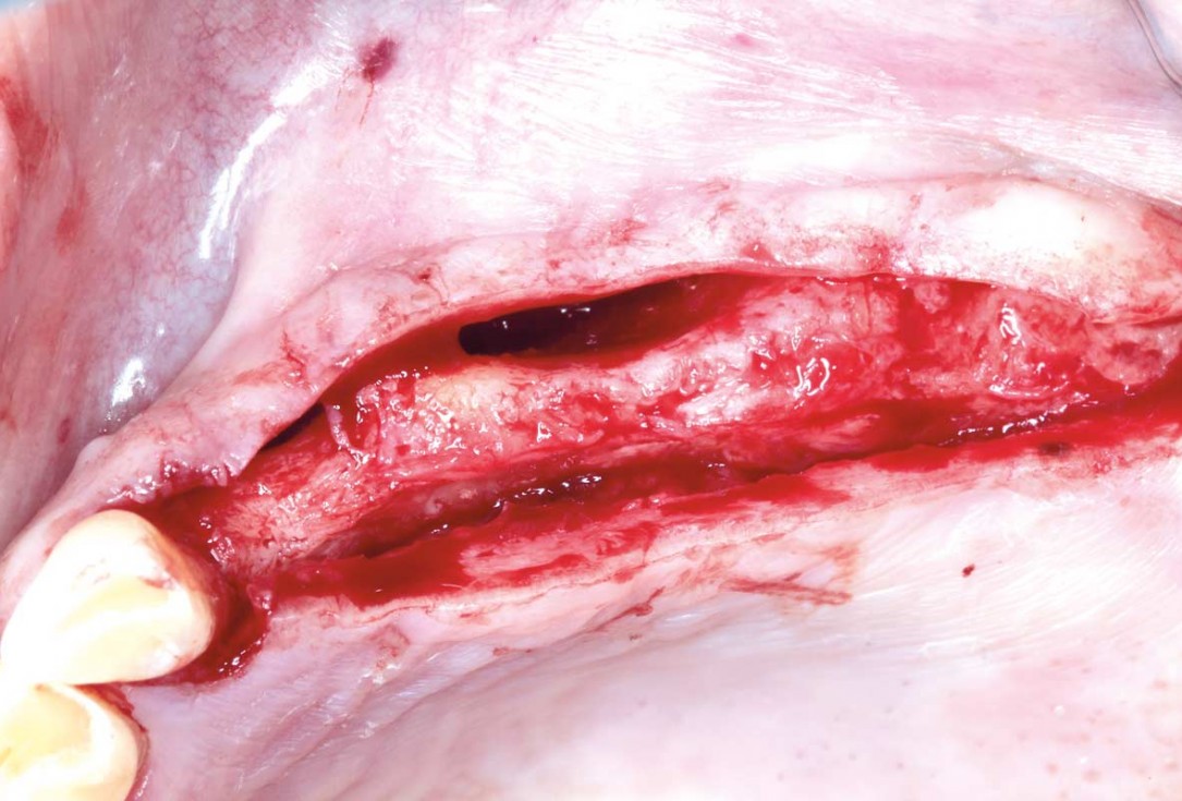 Horizontal ridge augmentation with permamem®, cerabone® and autologous bone chips - Dr. S. Pelekanos