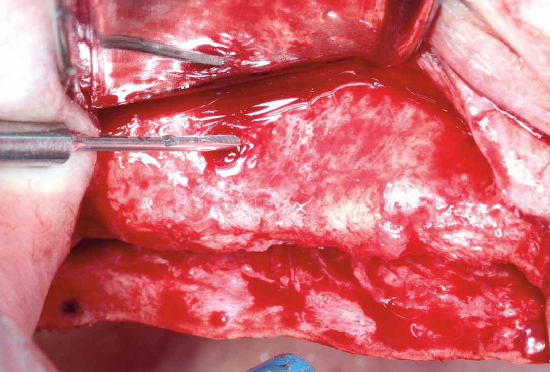 Horizontal ridge augmentation with permamem®, cerabone® and autologous bone chips - Dr. S. Pelekanos