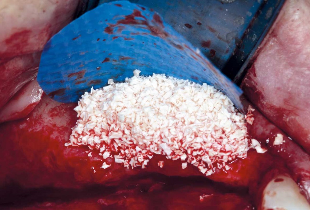 Horizontal ridge augmentation with permamem®, cerabone® and autologous bone chips - Dr. S. Pelekanos