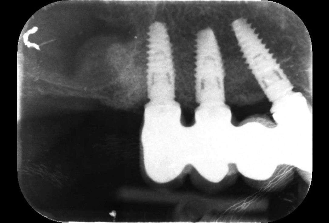 Horizontal ridge augmentation with permamem®, cerabone® and autologous bone chips - Dr. S. Pelekanos
