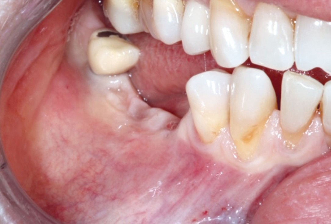 GBR with cerabone® and Jason® membrane DentalPro - Dr. A. Gargiulo 