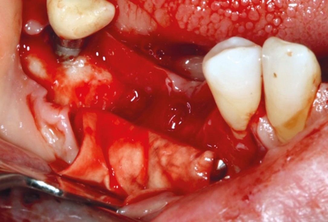 GBR with cerabone® and Jason® membrane DentalPro - Dr. A. Gargiulo 