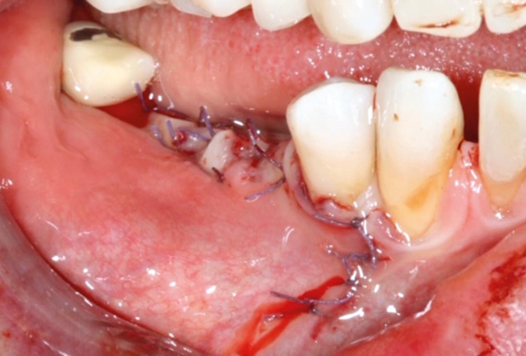 GBR with cerabone® and Jason membrane® DentalPro - Dr. A. Gargiulo 