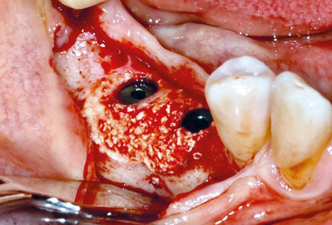 GBR with cerabone® and Jason membrane® DentalPro - Dr. A. Gargiulo 