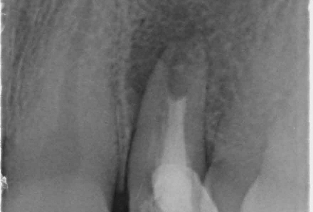 Block augmentation with maxgraft® in the maxilla - Dr. R. Cutts