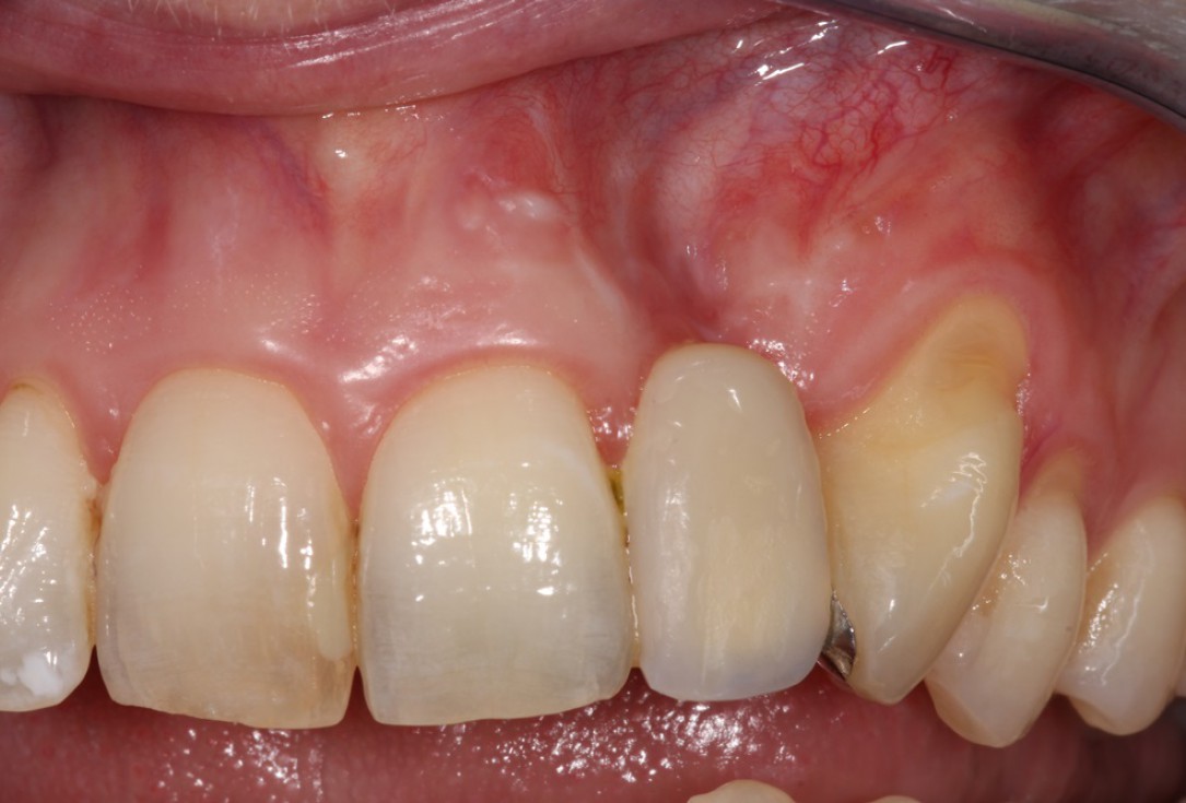 Block augmentation with maxgraft® in the maxilla - Dr. R. Cutts