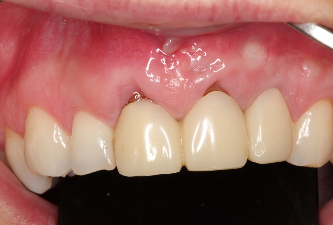 Multiple gingival recessions treated by MCAT in conjunction with mucoderm® and Straumann® Emdogain® (1) - Rathe
