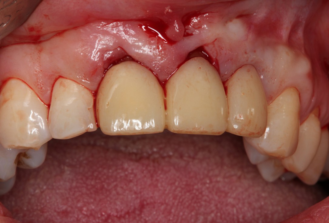 Multiple gingival recessions treated by MCAT in conjunction with mucoderm® and Straumann® Emdogain® (1) - Rathe