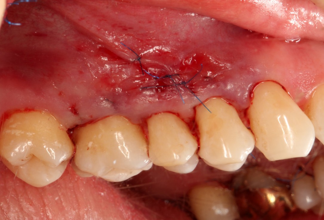 Multiple gingival recessions treated by MCAT with mucoderm® and Straumann® Emdogain® (2) - Rathe (2)