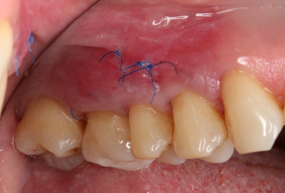 Multiple gingival recessions treated by MCAT with mucoderm® and Straumann® Emdogain® (2) - Rathe