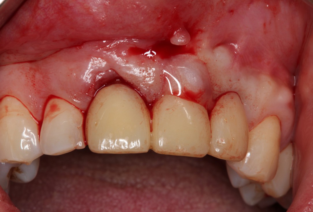 Multiple gingival recessions treated by MCAT in conjunction with mucoderm® and Straumann® Emdogain® (1) - Rathe