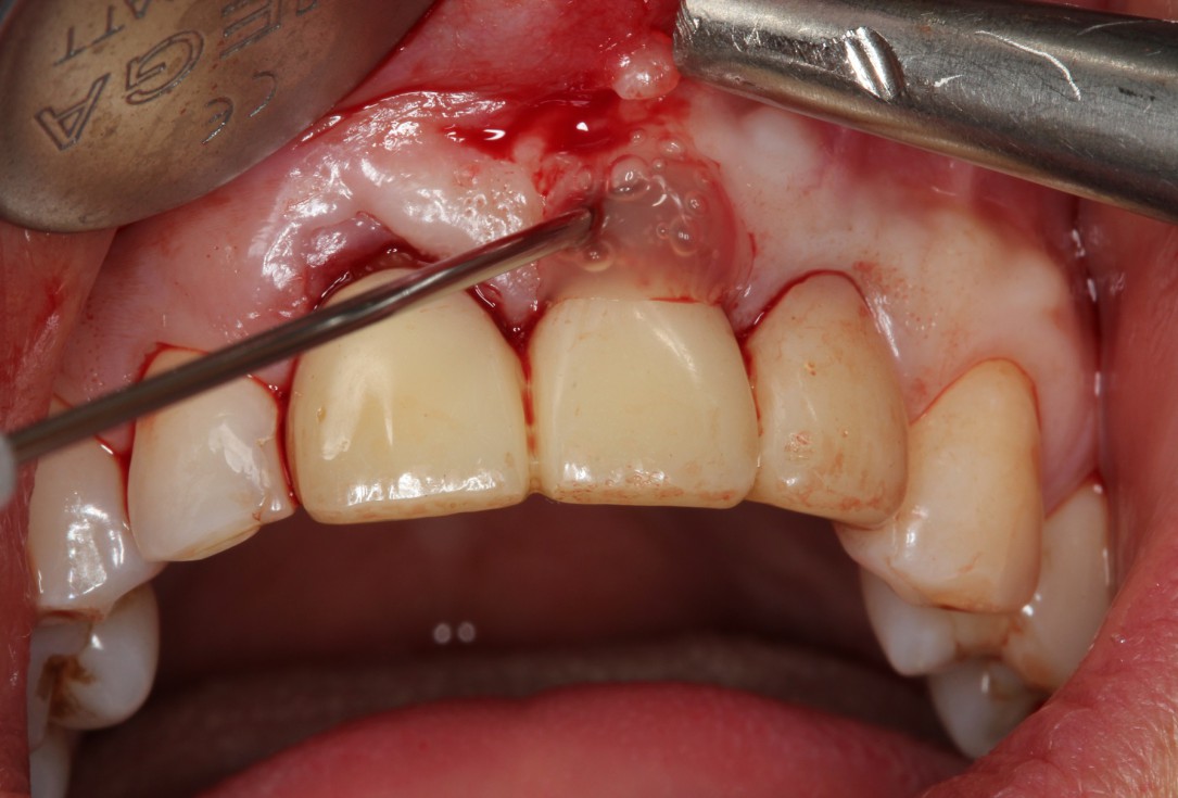 Multiple gingival recessions treated by MCAT in conjunction with mucoderm® and Straumann® Emdogain® (1) - Rathe
