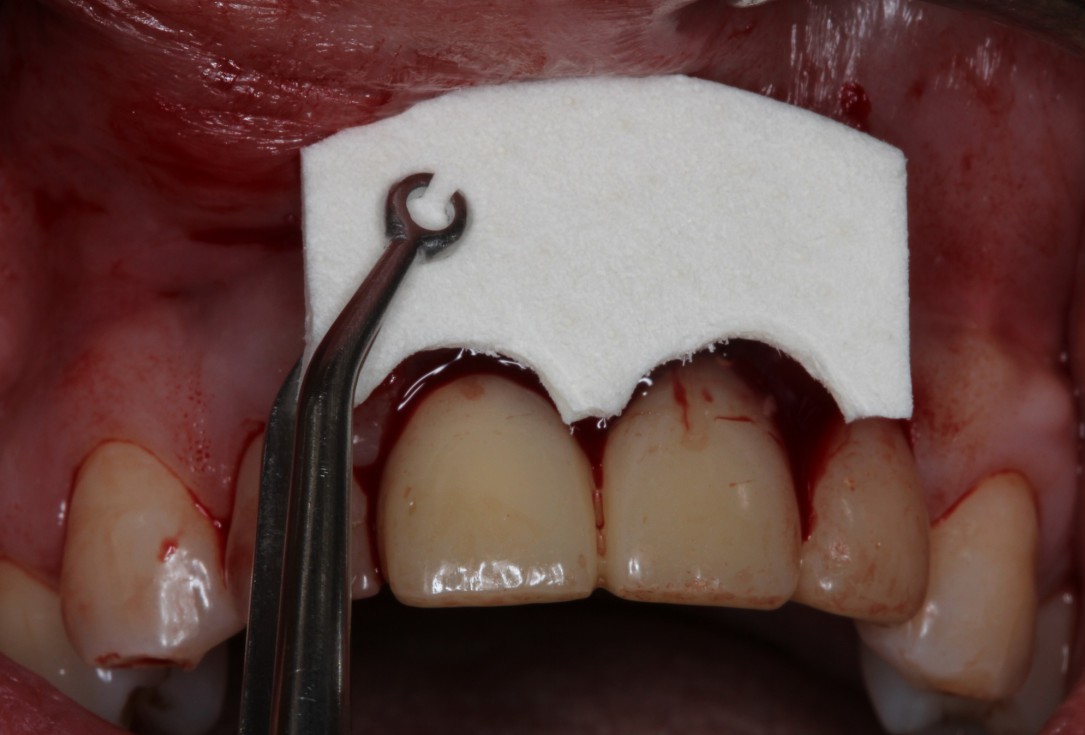 Multiple gingival recessions treated by MCAT in conjunction with mucoderm® and Straumann® Emdogain® (1) - Rathe