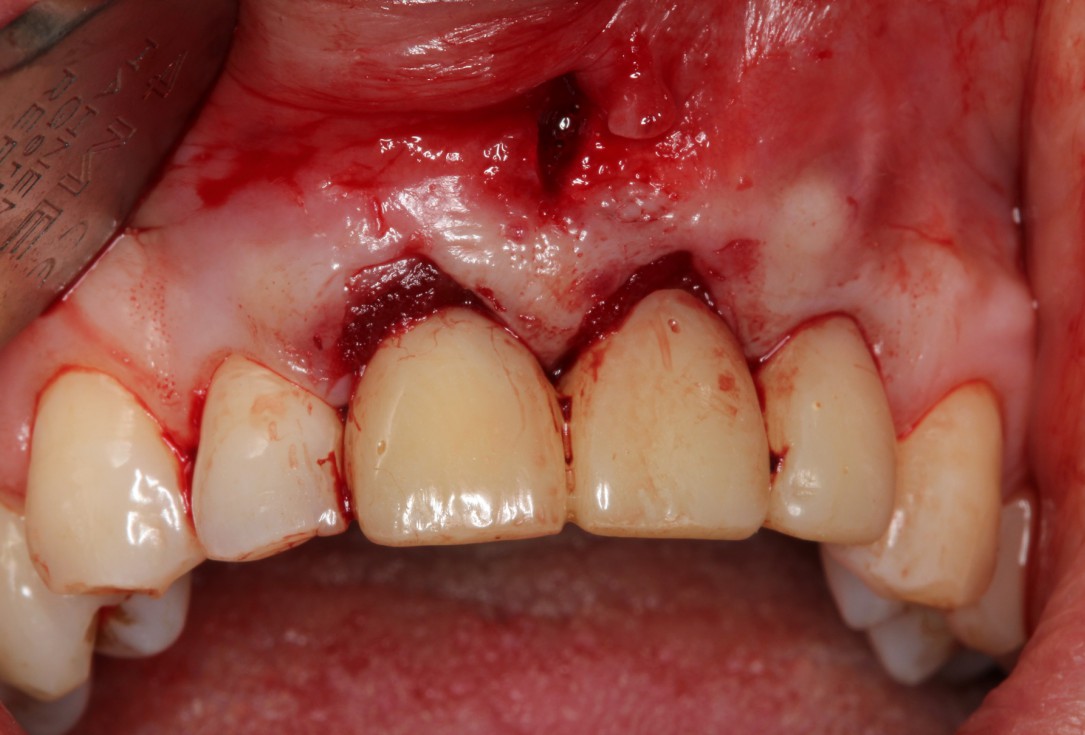 Multiple gingival recessions treated by MCAT in conjunction with mucoderm® and Straumann® Emdogain® (1) - Rathe