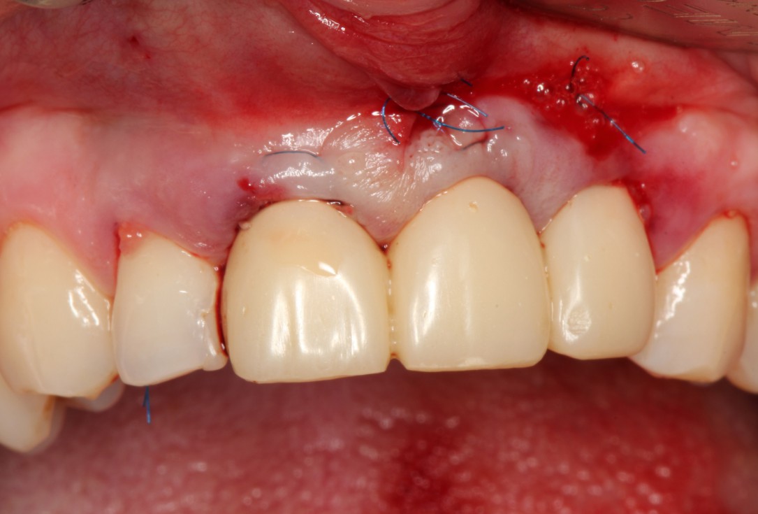 Multiple gingival recessions treated by MCAT in conjunction with mucoderm® and Straumann® Emdogain® (1) - Rathe