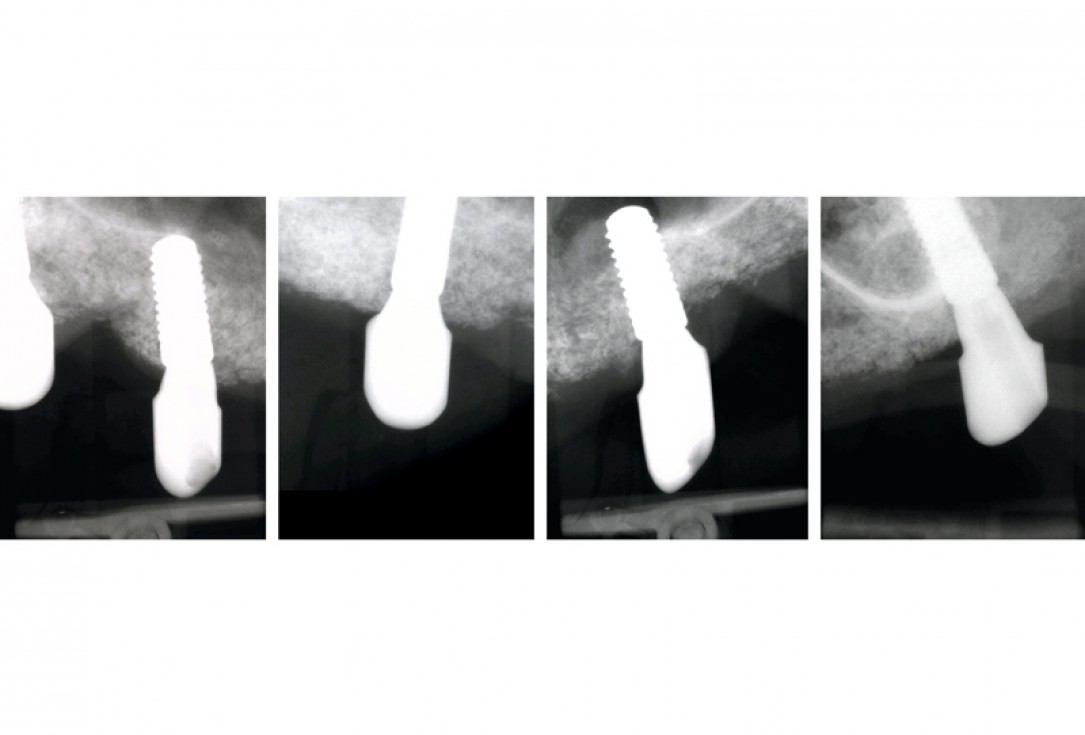botiss maxgraft® bonebuilder for maxilla reconstruction - Clinical case