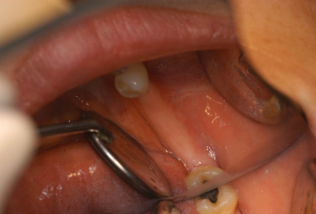 Ridge augmentation with cerabone® and Jason® membrane - Dr. M. Steigmann