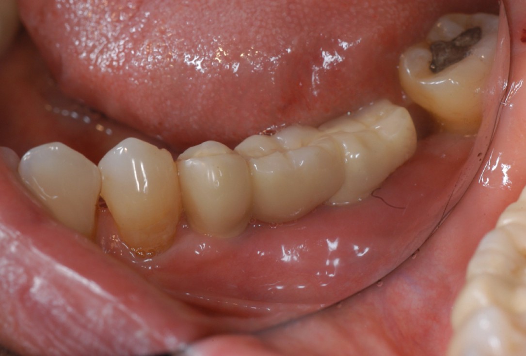 Ridge augmentation with cerabone® and Jason® membrane - Dr. M. Steigmann