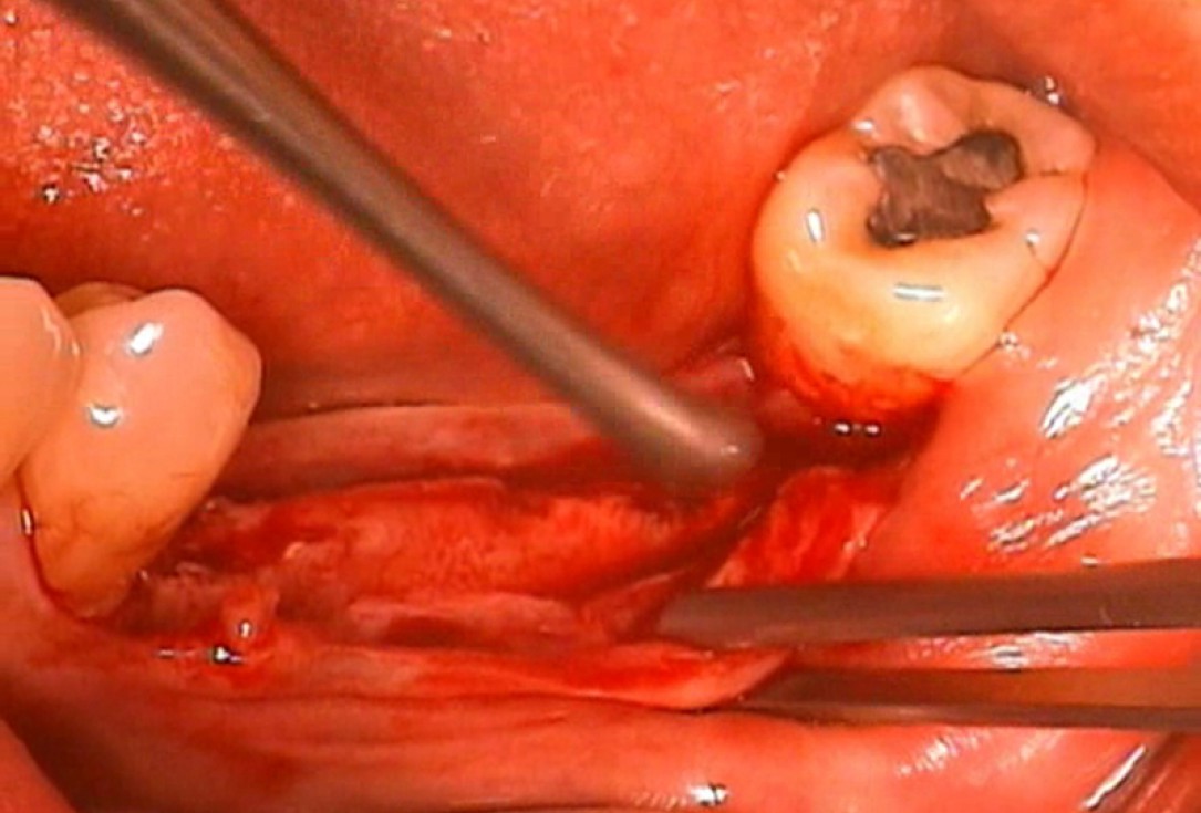 Ridge augmentation with cerabone® and Jason® membrane - Dr. M. Steigmann
