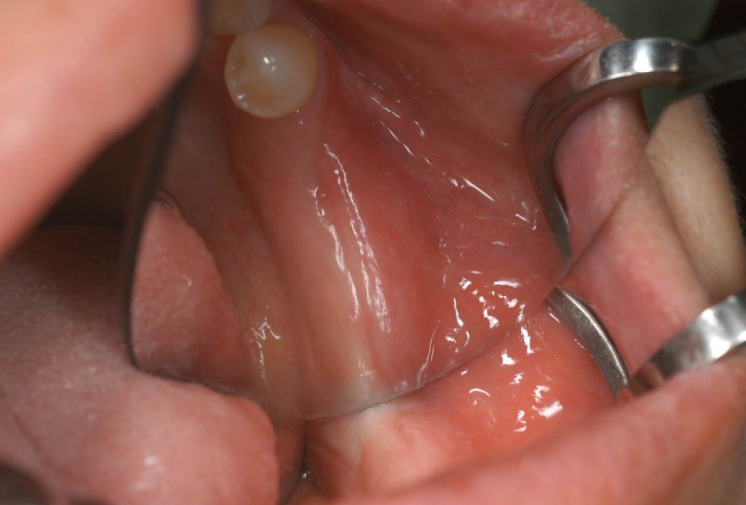 Ridge augmentation with cerabone® and Jason® membrane - Dr. M. Steigmann