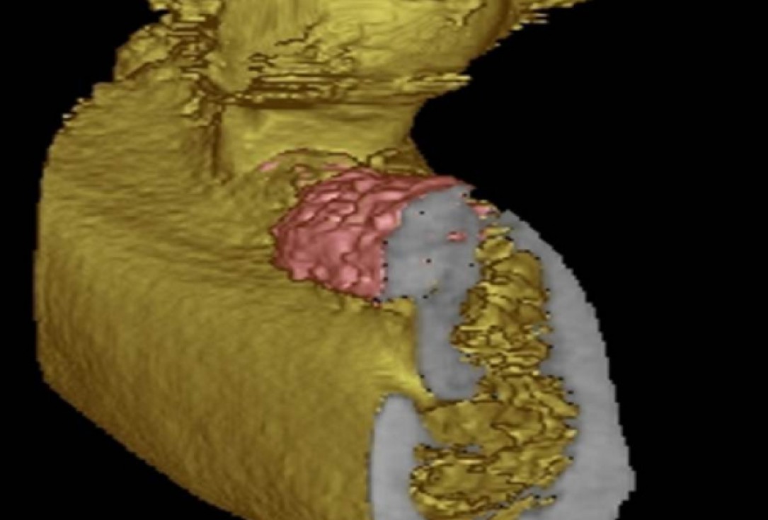 Ridge augmentation with cerabone® and Jason® membrane - Dr. M. Steigmann