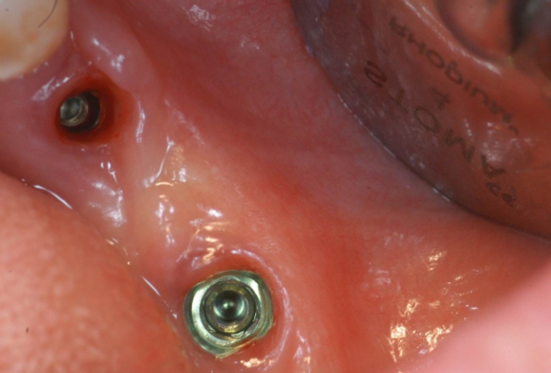 Ridge augmentation with cerabone® and Jason® membrane - Dr. M. Steigmann