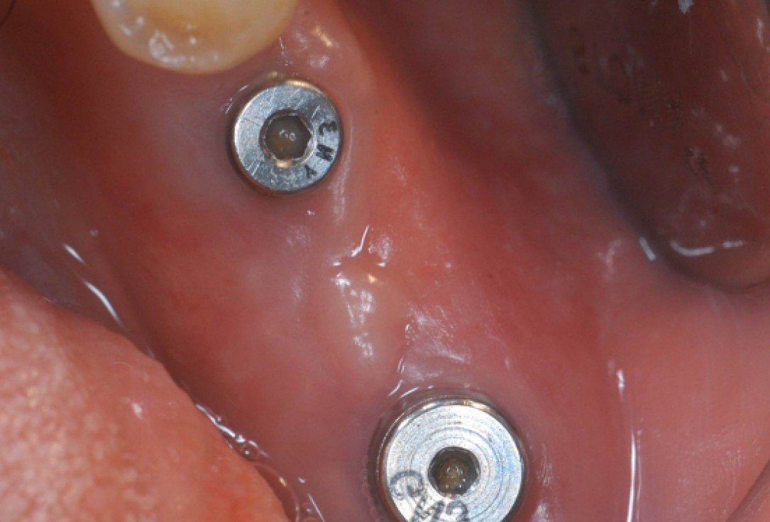 Ridge augmentation with cerabone® and Jason® membrane - Dr. M. Steigmann