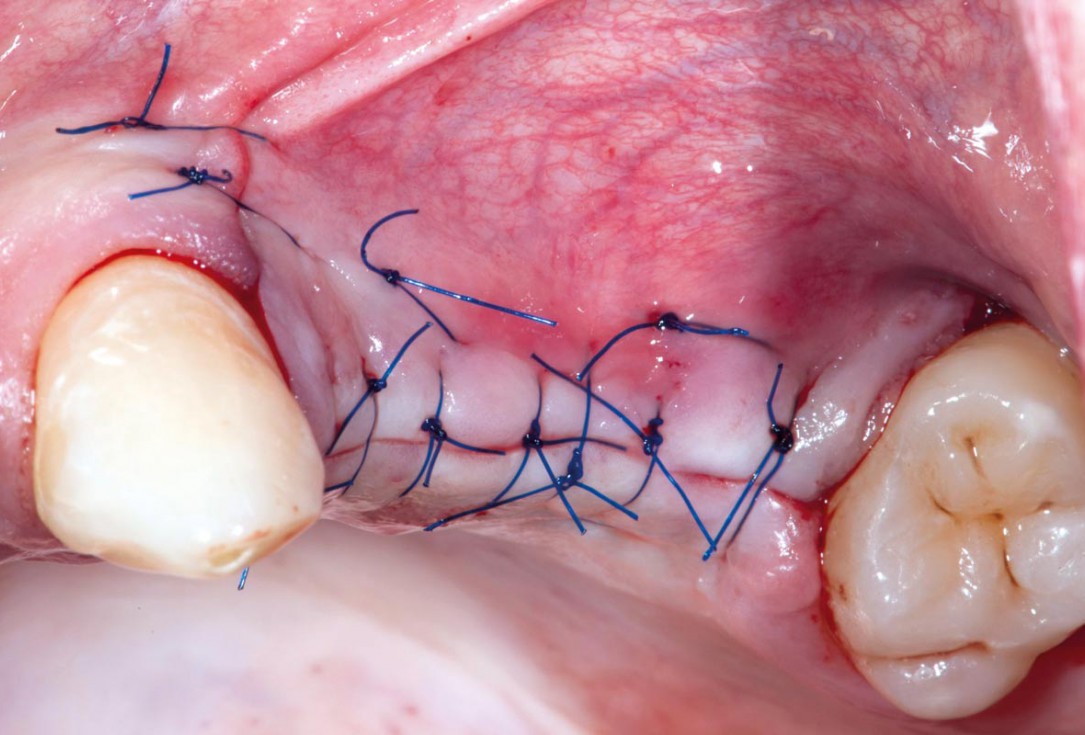 Sinus Floor Elevation with maxgraft® bonering and subcrestal implantation in an eggshell thin sinus - Dr. K. Chmielewski