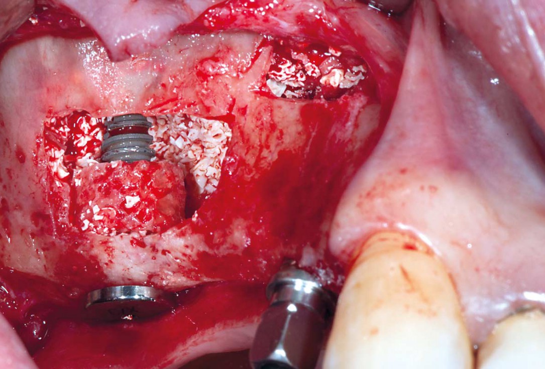 Sinus Floor Elevation with maxgraft® bonering and subcrestal implantation in an eggshell thin sinus - Dr. K. Chmielewski