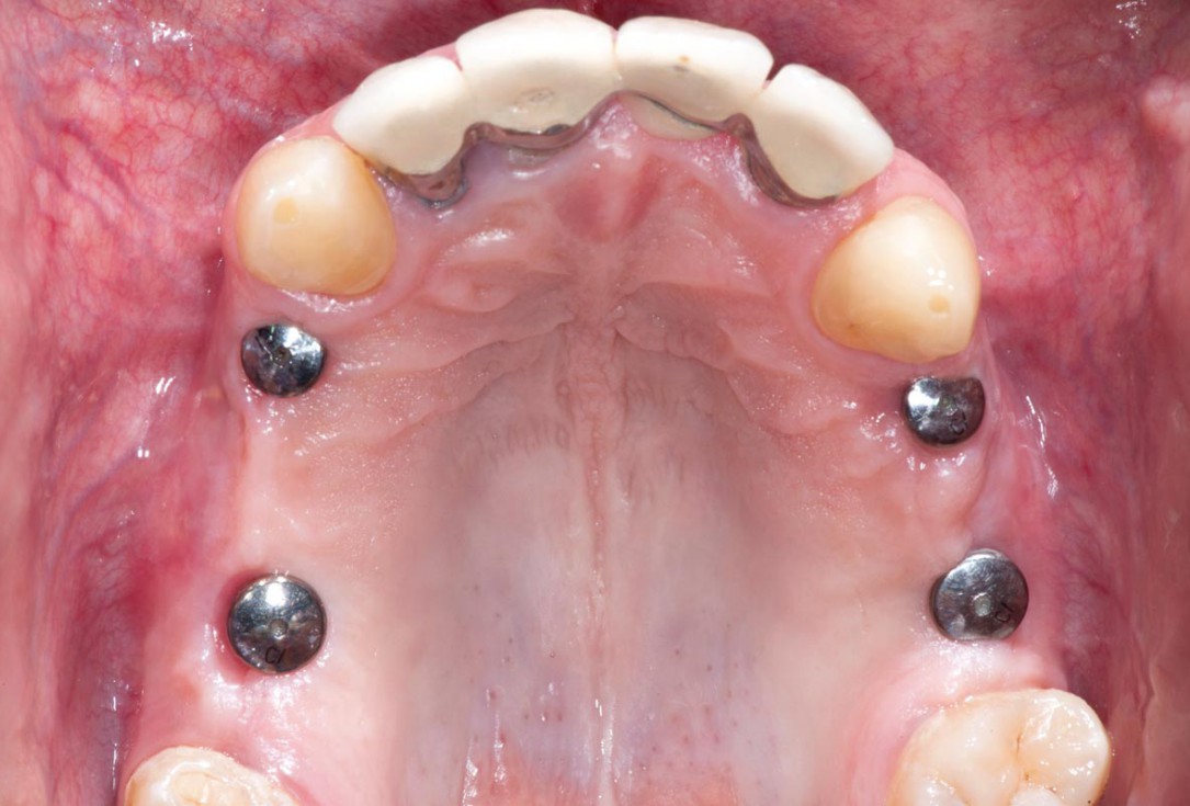 Sinus Floor Elevation with maxgraft® bonering and subcrestal implantation in an eggshell thin sinus - Dr. K. Chmielewski