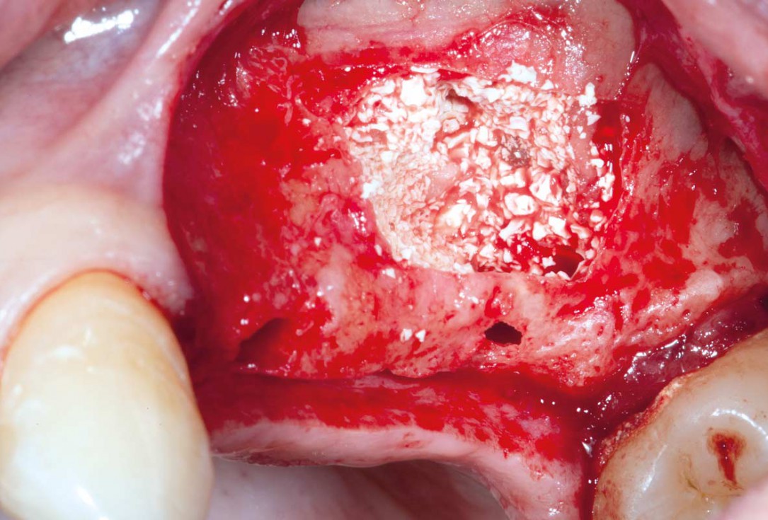 Sinus Floor Elevation with maxgraft® bonering and subcrestal implantation in an eggshell thin sinus - Dr. K. Chmielewski